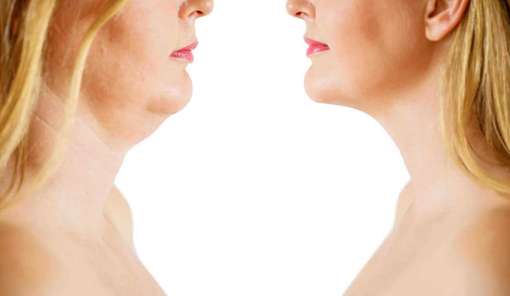 Double Chin treatment Nottingham before and after results