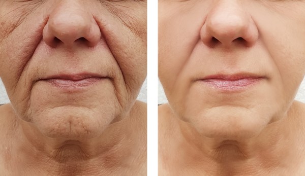 Learn more about Morpheus8 Treatment Nottingham today!