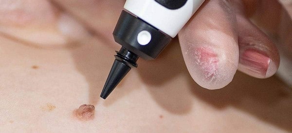 After Skin Tag Removal Nottingham