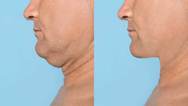 Which Non-Surgical Treatments Work Best for Jowls and Loose Skin Nottingham?