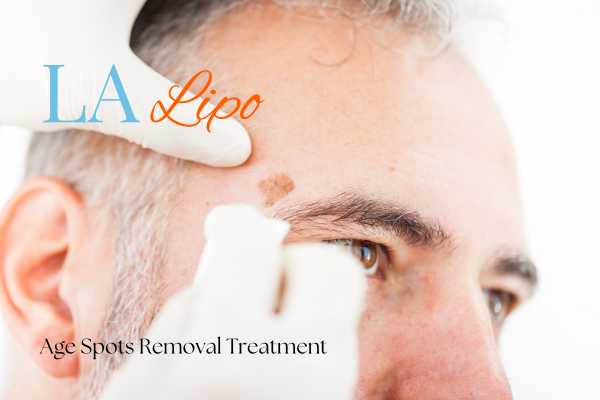 What Are the Most Effective Treatments for Age Spots Nottingham?