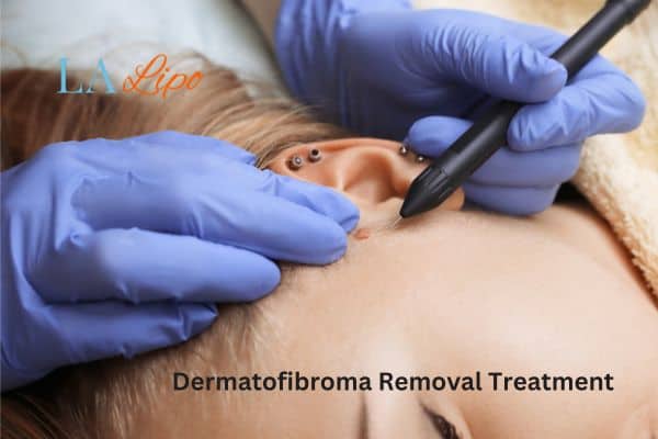 Dermatofibroma Removal Treatment Nottingham