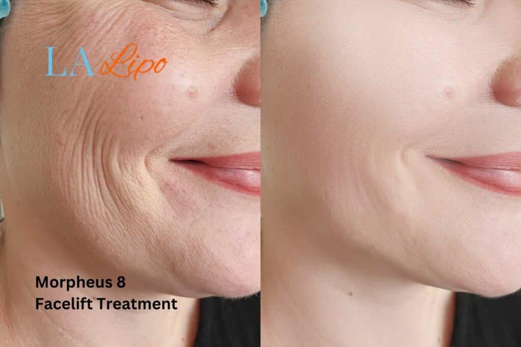 Morpheus8 Treatment Nottingham for flawless skin! Call us today!