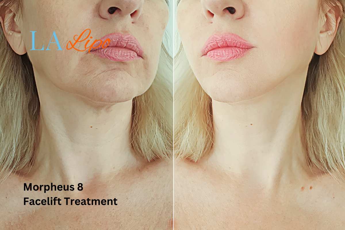 Turn back time with Morpheus8 Treatment Nottingham