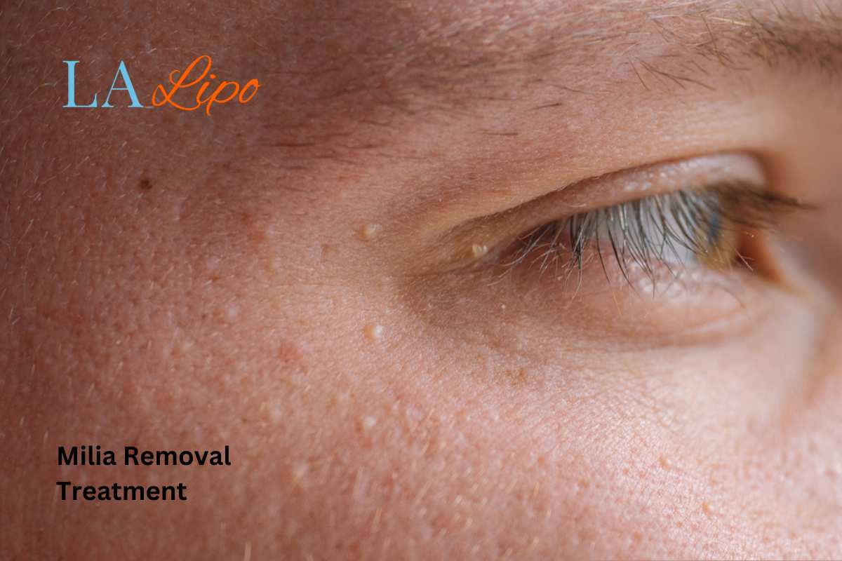 Cryopen Milia Removal: Is It the Easiest and Safest Option Nottingham?