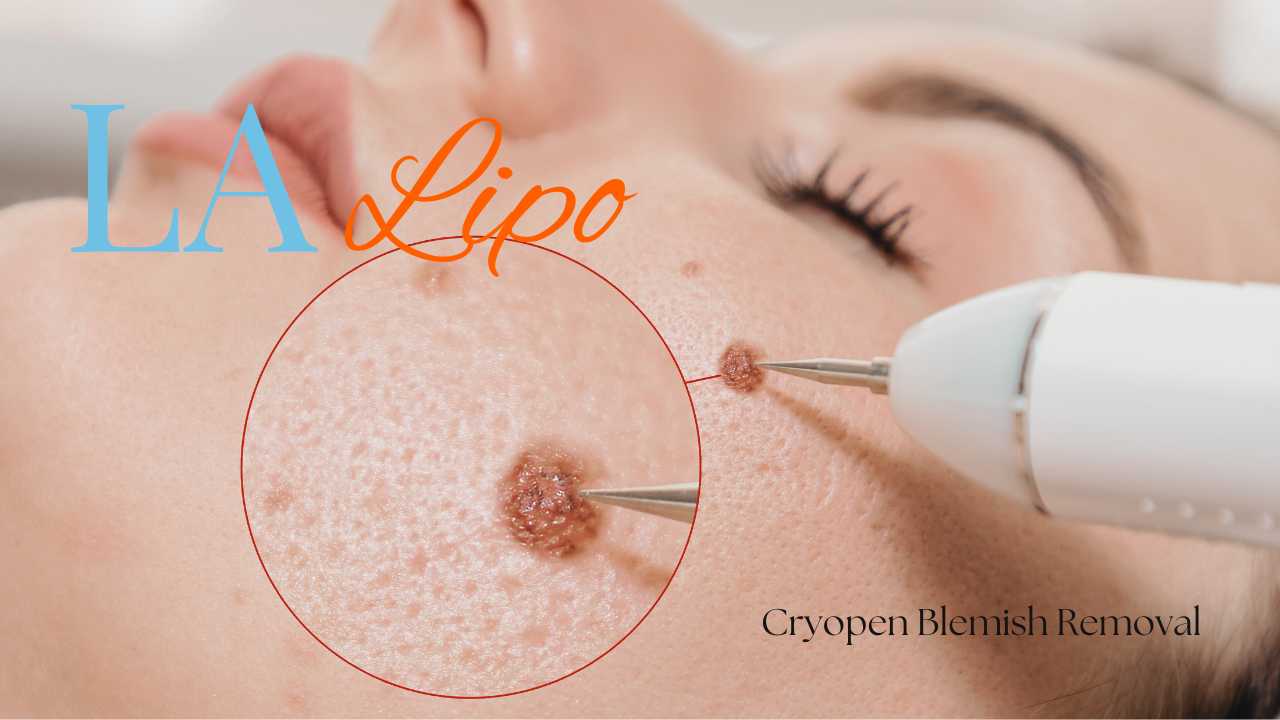 cryopen blemish removal Nottingham Contact our team today!
