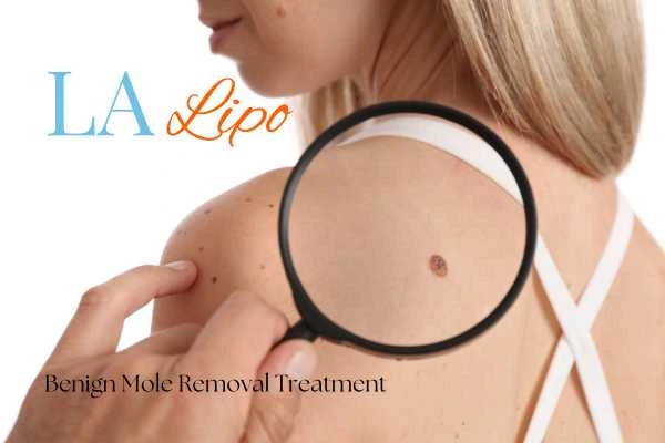 Woman having her inspection of blemish before mole removal Nottingham