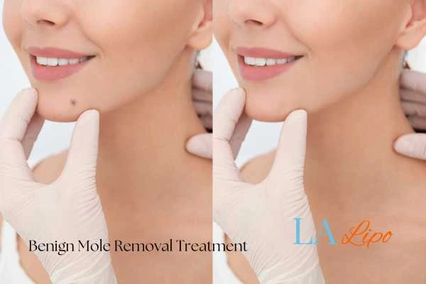 woman's before and after mole removal Nottingham results