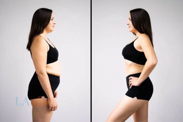 image of woman before and after results of LA-EMS Body Sculpting Nottingham to help treat Diastasis recti
