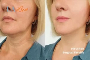 hi-fu for wrinkles Nottingham before and after results