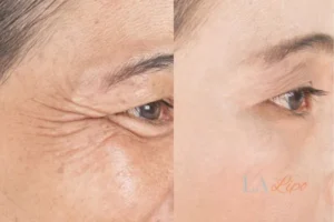 Before and after results of woman - HI-fu wrinkles reduction treatment Nottingham