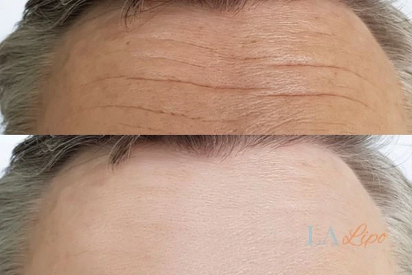 results of HIFU Nottingham on mans forehead to help reduce lines and wrinkles