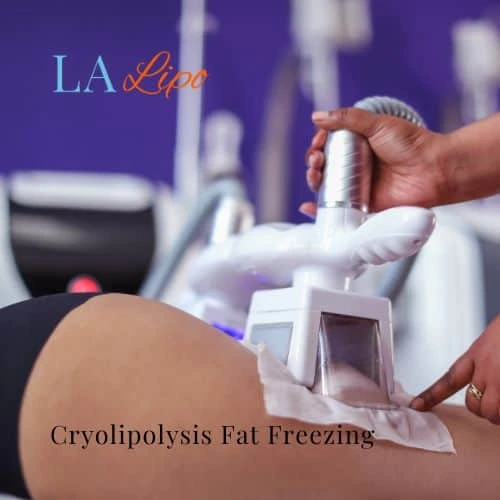 fat freezing - Cryolipolysis Nottingham