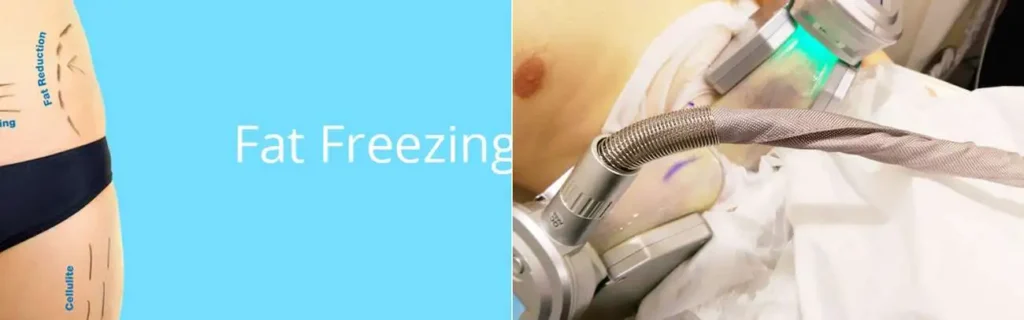 multi areas of a persons body having coolsculpting Nottingham treatment