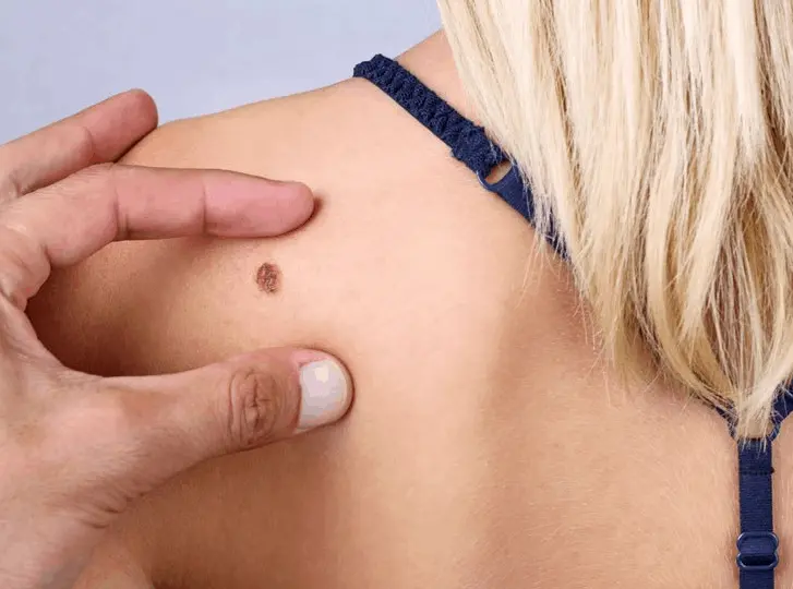 woman having mole removal Nottingham consultation before treatment.