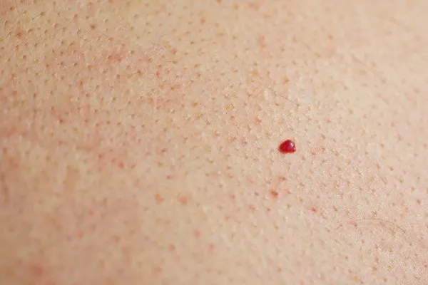 close up of a cherry angioma Nottingham