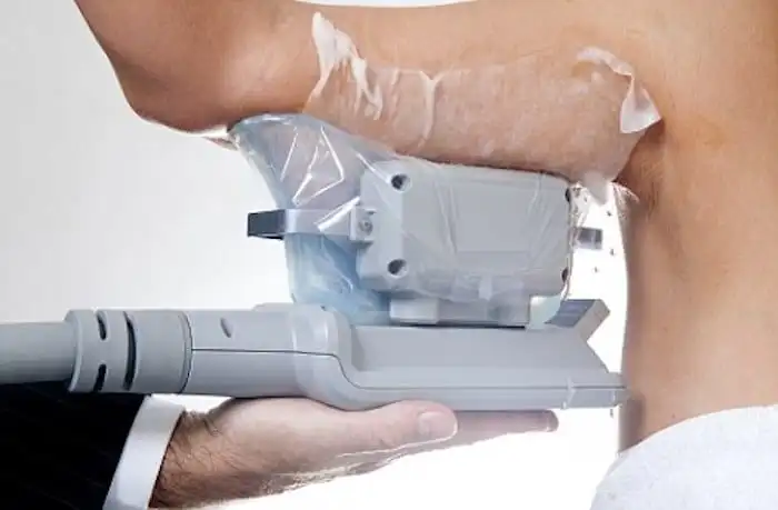 Picture of fat freezing Nottingham on the upper arms.