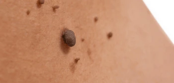 image of a skin tag Nottingham