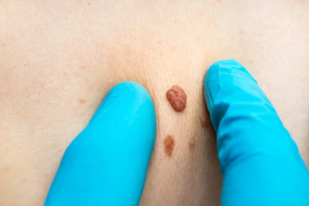 Consultant examining a skin tag Nottingham