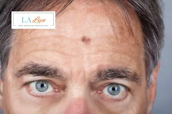 Solar Lentigo Removal Nottingham image of man with mark on his forehead