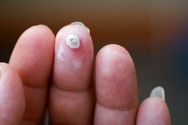 wart on person finger - cryotherapy to treat from LA LIPO Nottingham