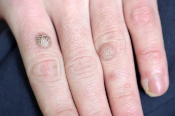 photo of warts on person hand - see wart removal Nottingham from LA LIPO