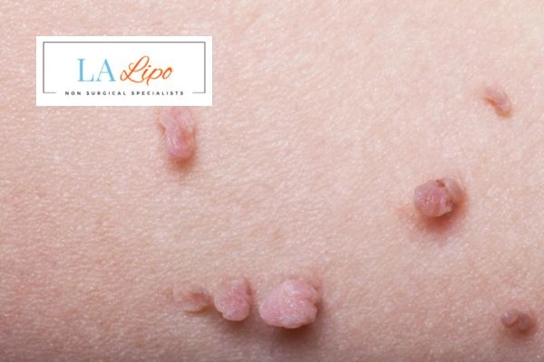 Does cryopen skin tag removal Nottingham hurt? Find out now call our team today!