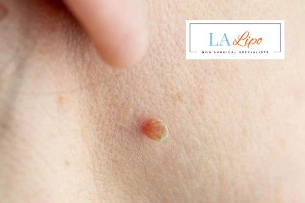 Book skin tag removal Nottingham today speak to our team now!
