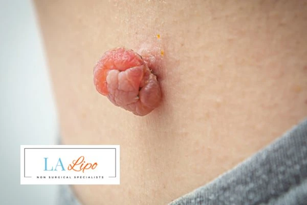Interested in skin tag removal Nottingham? Concerned about the pain? Find out more today!