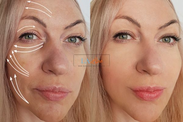 Morpheus 8 results Nottingham face lift.