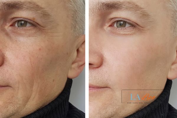 See the amazing results of Morpheus8 Treatment Nottingham!