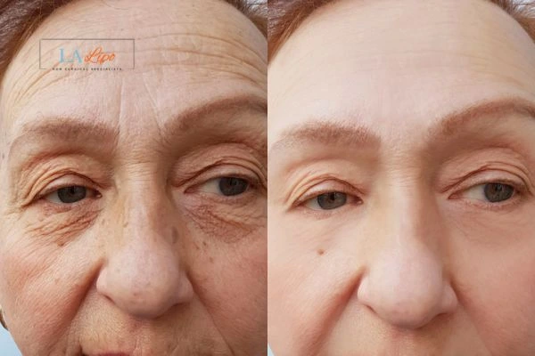 The powerful benefits of Morpheus8 Treatment Nottingham - Call Our team today!