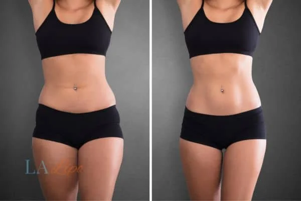 before and after results of non-surgical treatment to help a woman's body image and mental health Nottingham