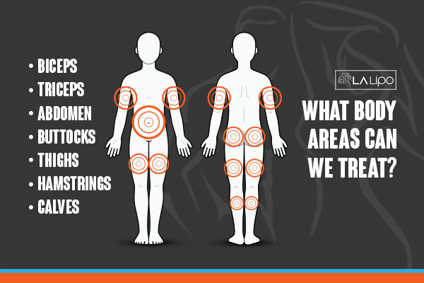 Diagram to show areas you can have LA-EMS Body Sculpting Treatment Nottingham