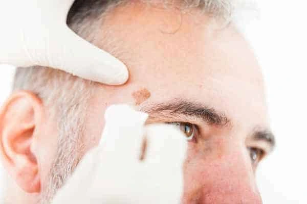 Age spots and elderly people Nottingham what is the link?