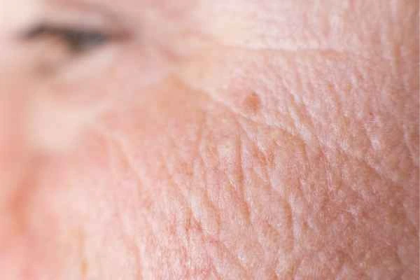 close up picture of a woman's face showing an age spot Nottingham