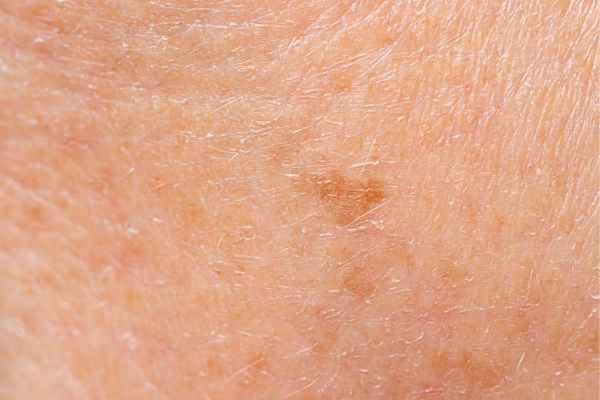 close up picture of age spots Nottingham