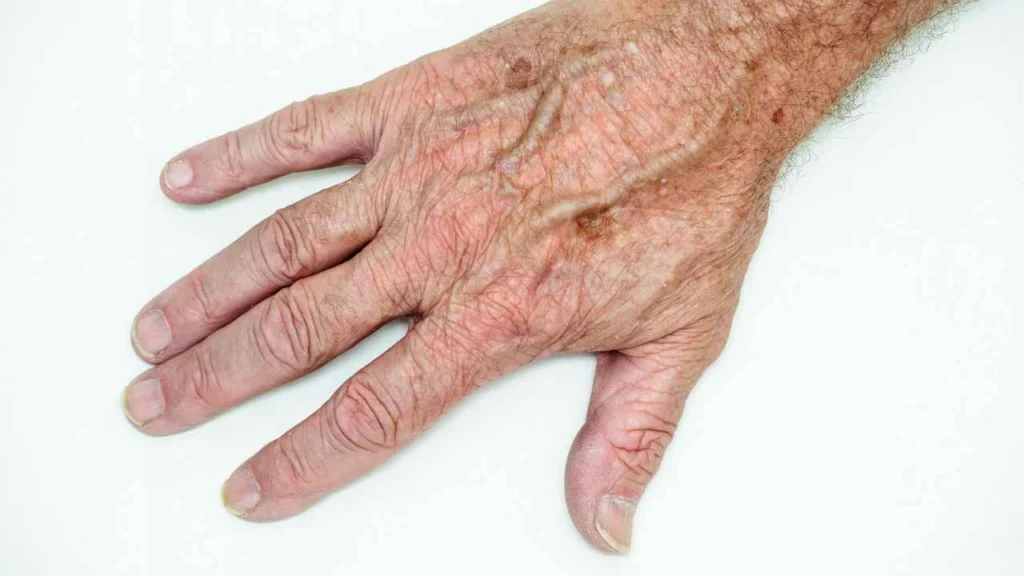Male hand showing age spot Nottingham