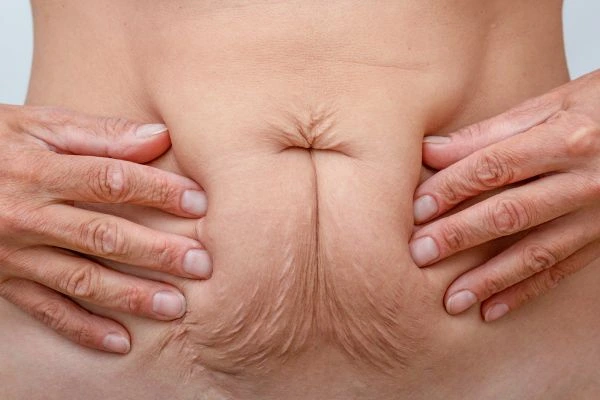 Image of a woman's stomach with loose skin - example of skin tightening Nottingham options