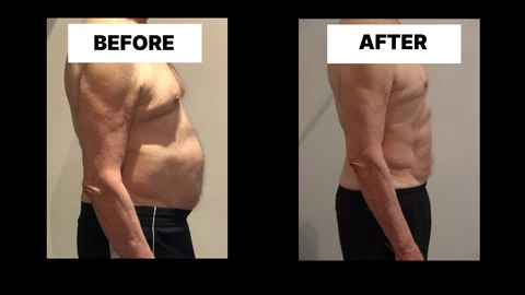 What Symptoms Can Diastasis Recti Cause in Men? Weak Core, Back Pain and Poor Posture Nottingham